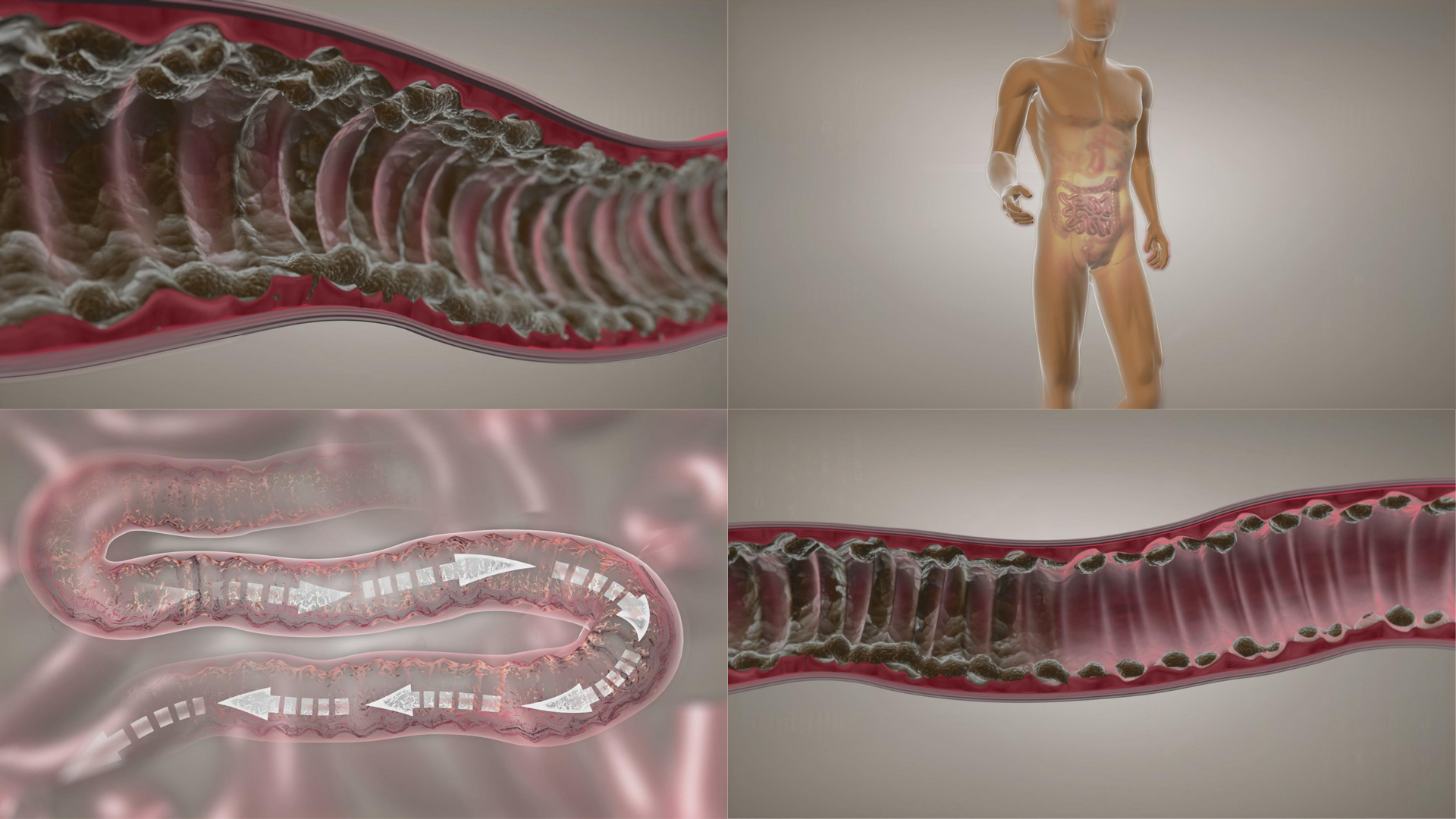 毒素宿便在肠道内堆积视频的预览图