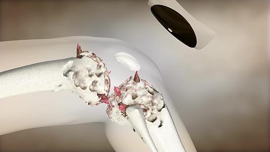 治疗膝关节炎骨刺药物粒子三维动画素材视频的预览图