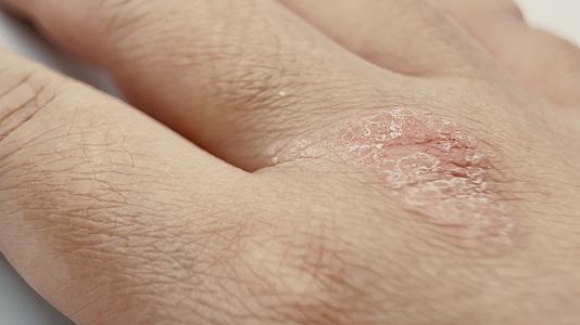 手臂湿疹皮肤瘙痒挠视频的预览图
