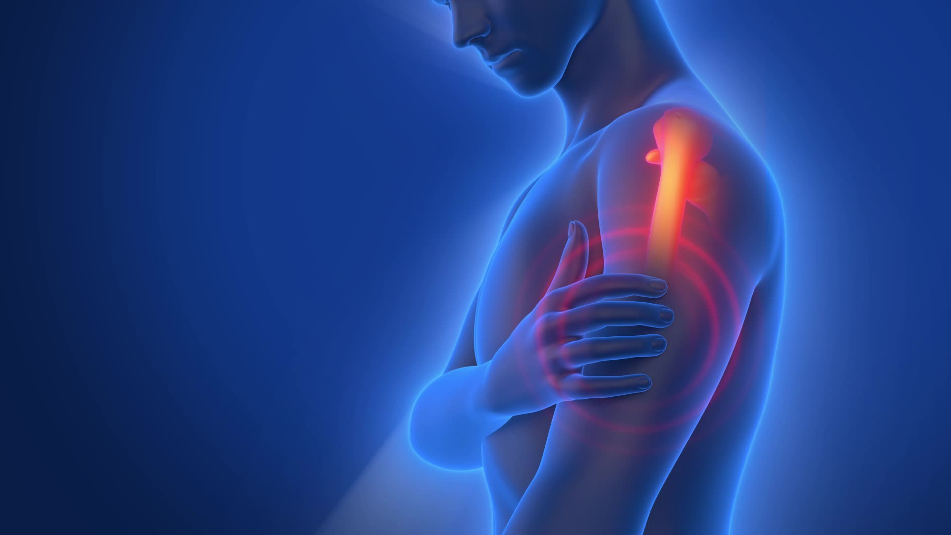 肩周炎肩膀疼痛三维模拟动画视频的预览图