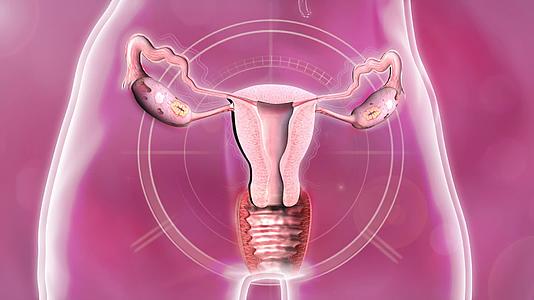 女性生殖系统内壁皱折淤积病变过程视频的预览图