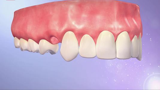 牙齿种植手术及修复3D动画演示视频的预览图