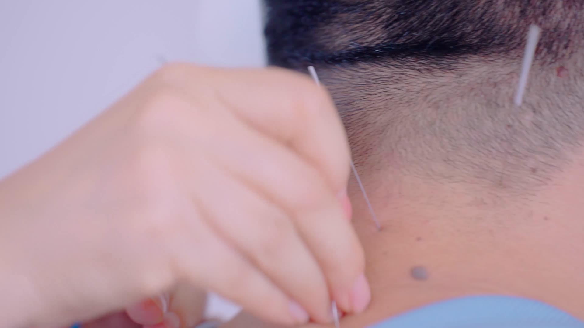 中医针灸实拍视频视频的预览图