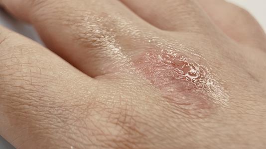 手臂湿疹皮肤瘙痒挠视频的预览图
