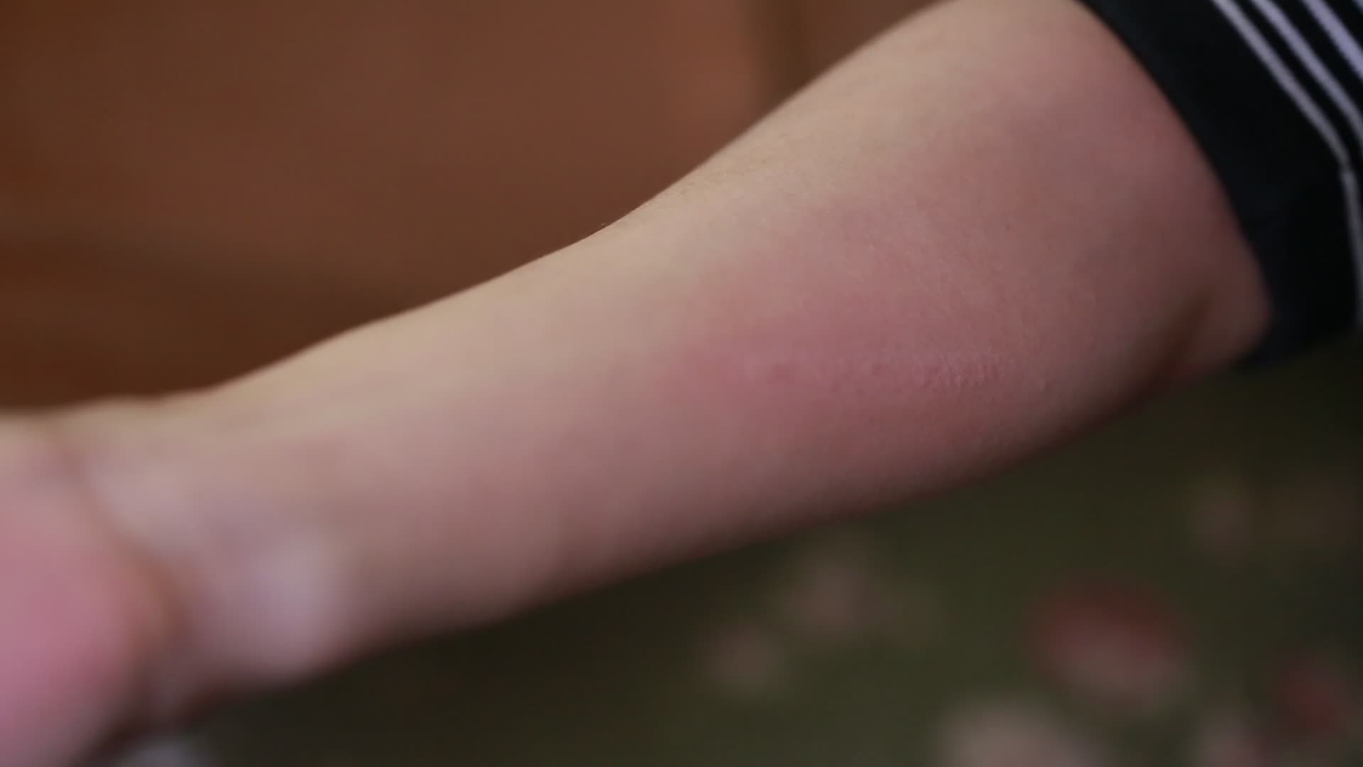 胳膊过敏荨麻疹丘疹视频的预览图