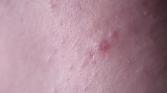 皮肤问题痤疮长痘痘印视频的预览图